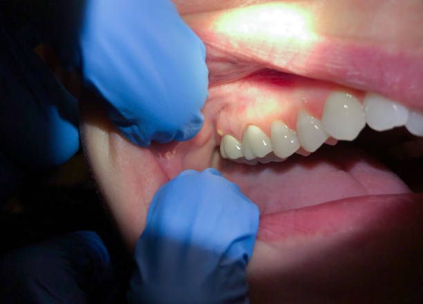 Best Broken or Cracked Tooth Emergency Dentist in Yarmouth Port, MA